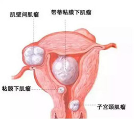 子宮肌瘤千萬不能割，誰割誰后悔